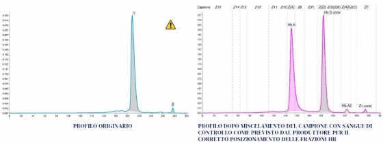 Caso n. 4 - Quando Hb A e Hb A2 e Hb F sono assenti