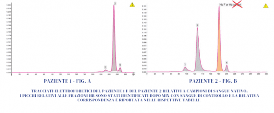 Caso n. 6 - Quando occorre distinguere la condizione di Hb E omozigote da un composto...