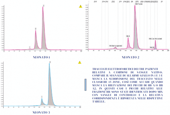 Caso n. 7 - Quando occorre interpretare un assetto Hb alla nascita